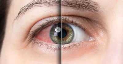 درمان خشکی چشم عینک ایگل کالا