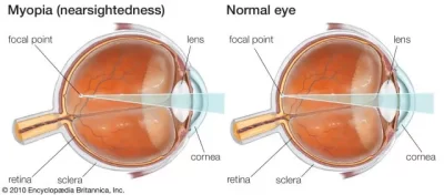 نزدیک بینی عینک ایگل کالا